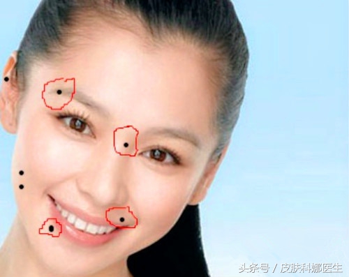 脸上的痣该不该点掉,女人脸上的痣哪些不能点掉