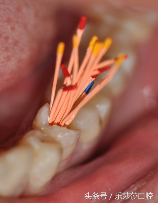 一根针扎进眼珠里会怎么样,一根针放进什么地方容易融化