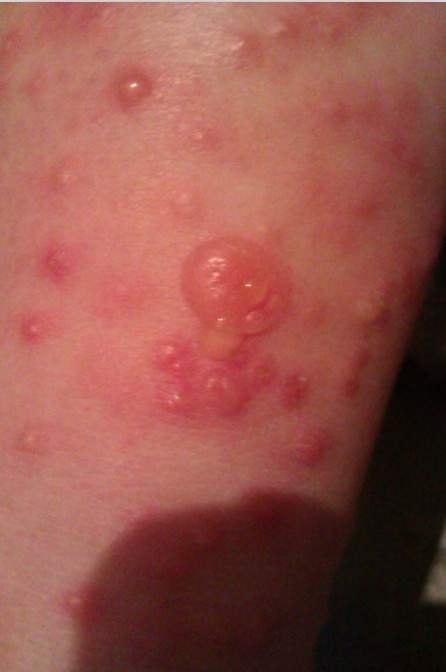 跳蚤咬伤发烧了,跳蚤咬伤疤痕怎么去除