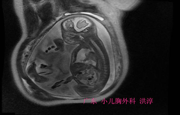 胎儿胸腔积液自己吸收的几率高吗,胎儿胸腔积液9mm严重吗