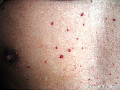 长鲜红斑痣民间中医能治吗,皮肤上像红痣的红疙瘩可以刺破吗