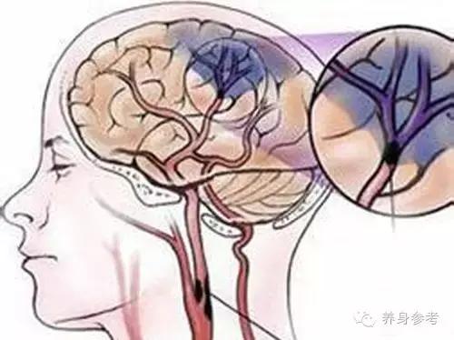 讲解脑血栓疾病的4大预防绝招,脑血栓患者秋天要注意什么