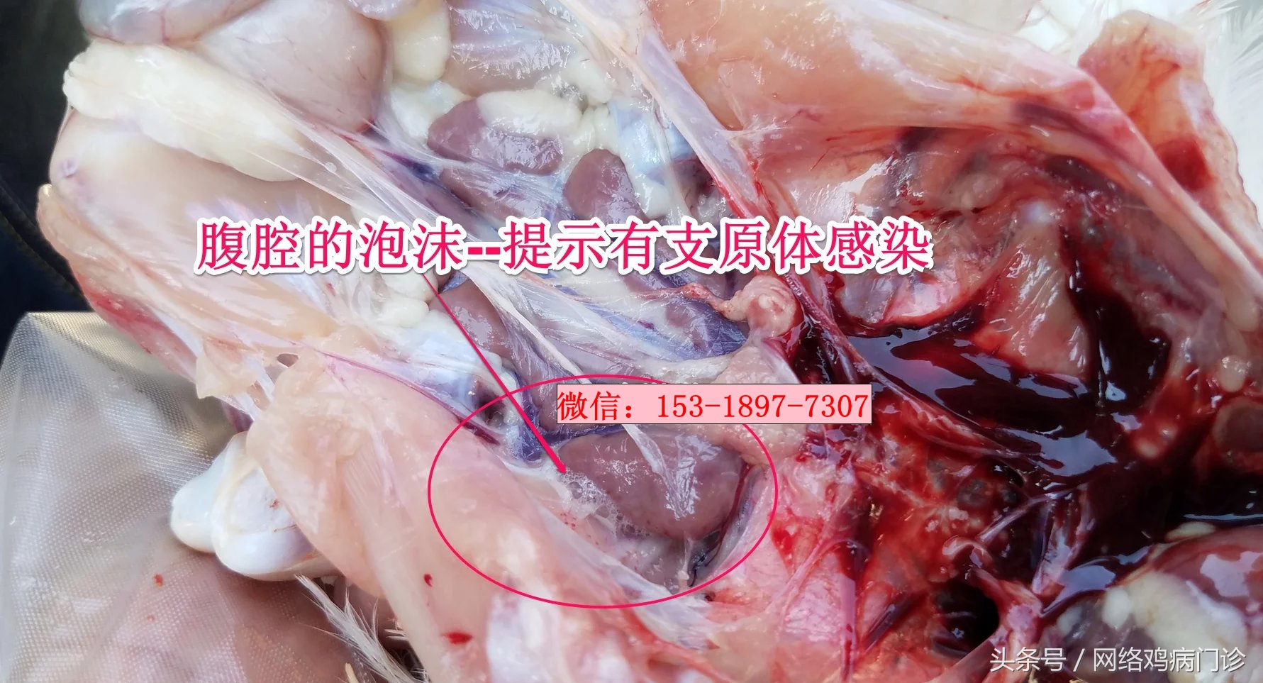 腺肌症治愈的病例分享,鸡腺肌胃炎的治疗成功案例