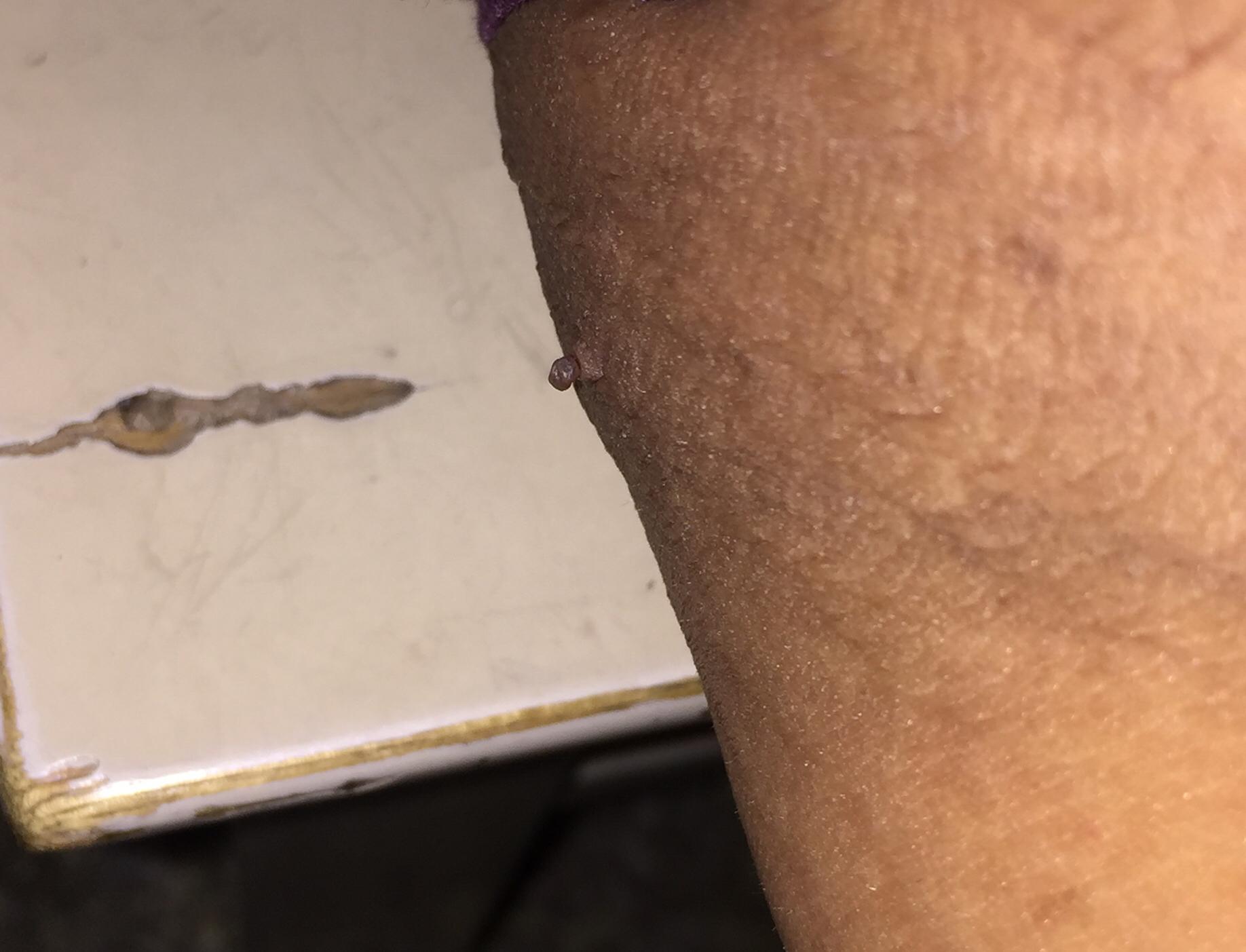 脖子上长瘊子可以用头发拴住吗,大腿上瘊子有什么说法