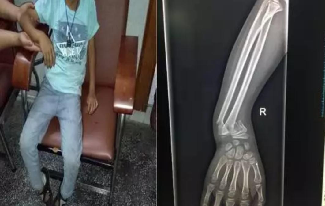 正骨治骨折的亲身经历,骨折有什么特效药治疗最好最快