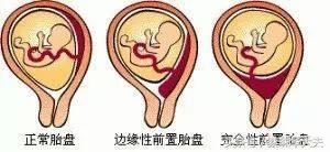 13周胎盘下缘达宫颈内口腹痛,怀孕13周胎盘覆盖宫颈内口严重吗