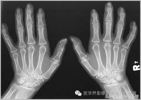 软组织钙化与骨化,软组织钙化和骨质增生