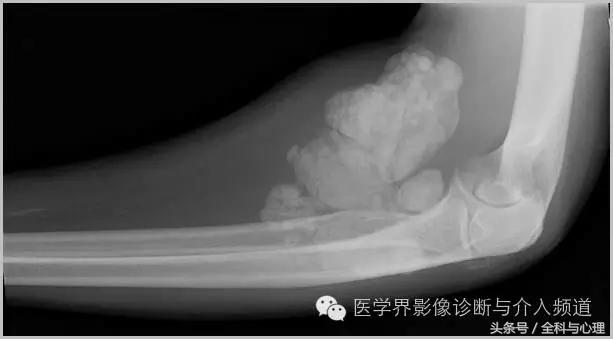 软组织钙化与骨化,软组织钙化和骨质增生