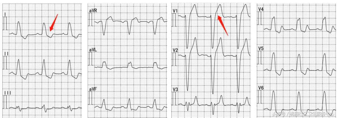 继发性stt异常是什么意思,心电图继发性st-t改变是什么意思