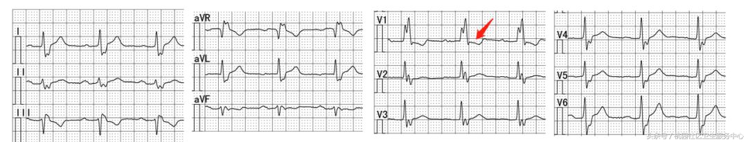 继发性stt异常是什么意思,心电图继发性st-t改变是什么意思