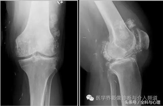 软组织钙化与骨化,软组织钙化和骨质增生
