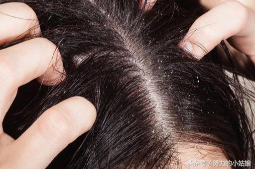 头上为什么会有螨虫?阿婆用一勺盐祛螨,千万螨虫落荒而逃