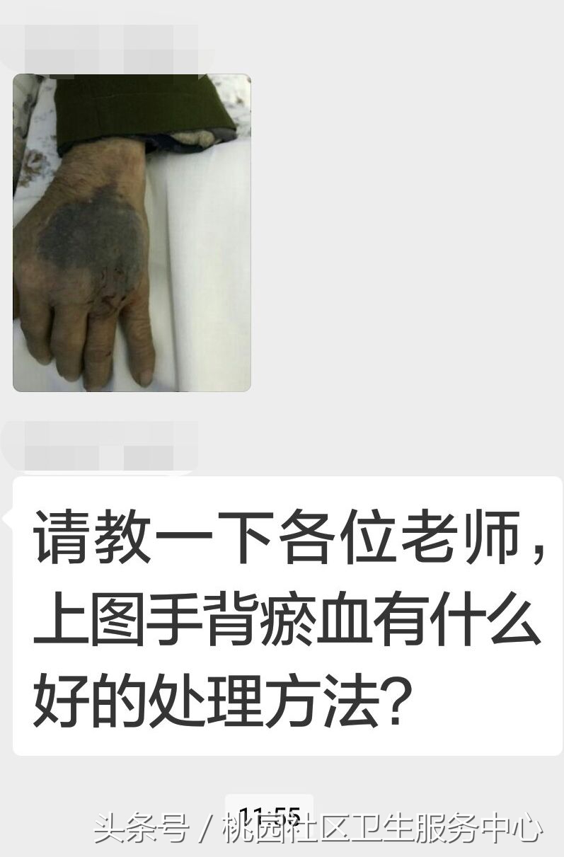 输液手背淤青疼怎么办,输液拔针后手背有淤血怎么处理