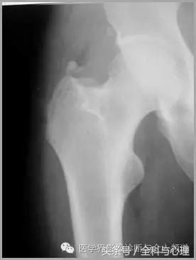 软组织钙化与骨化,软组织钙化和骨质增生