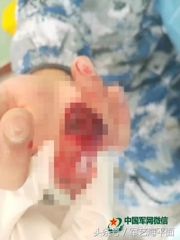 惊险！8小时“抢”回战士的手指