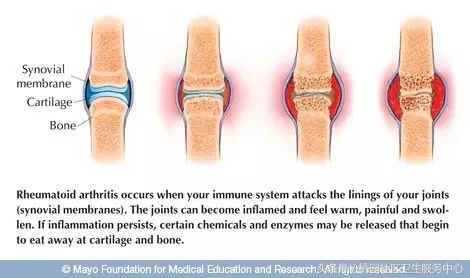 教你两步搞定类风湿关节炎,类风湿关节炎用土方法一招自愈