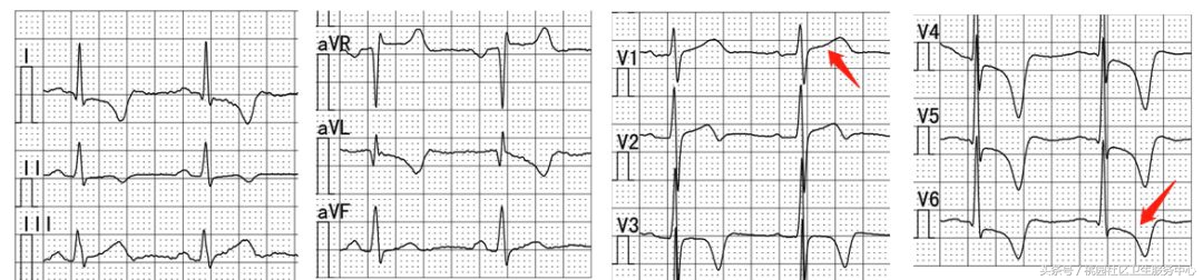 继发性stt异常是什么意思,心电图继发性st-t改变是什么意思