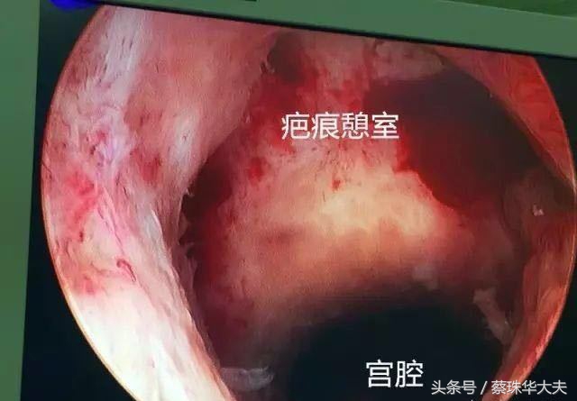 孕13周胎盘下缘覆盖宫颈口要紧吗,孕13周胎盘覆盖宫口