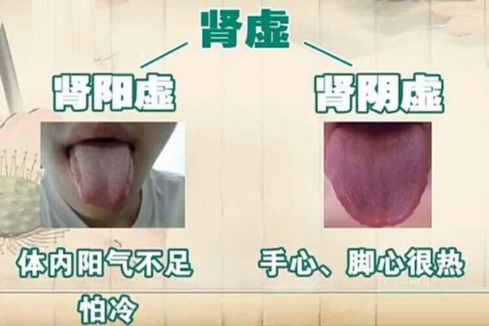 怎么判断肾阳虚肾阴虚阴阳两虚,有肾阴虚和肾阳虚的表现怎么办