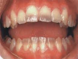 喝牛奶导致蛀牙,喝牛奶当心引起四环素牙