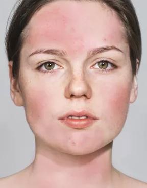 点阵激光祛痘印的副作用和危害,co2点阵激光危害