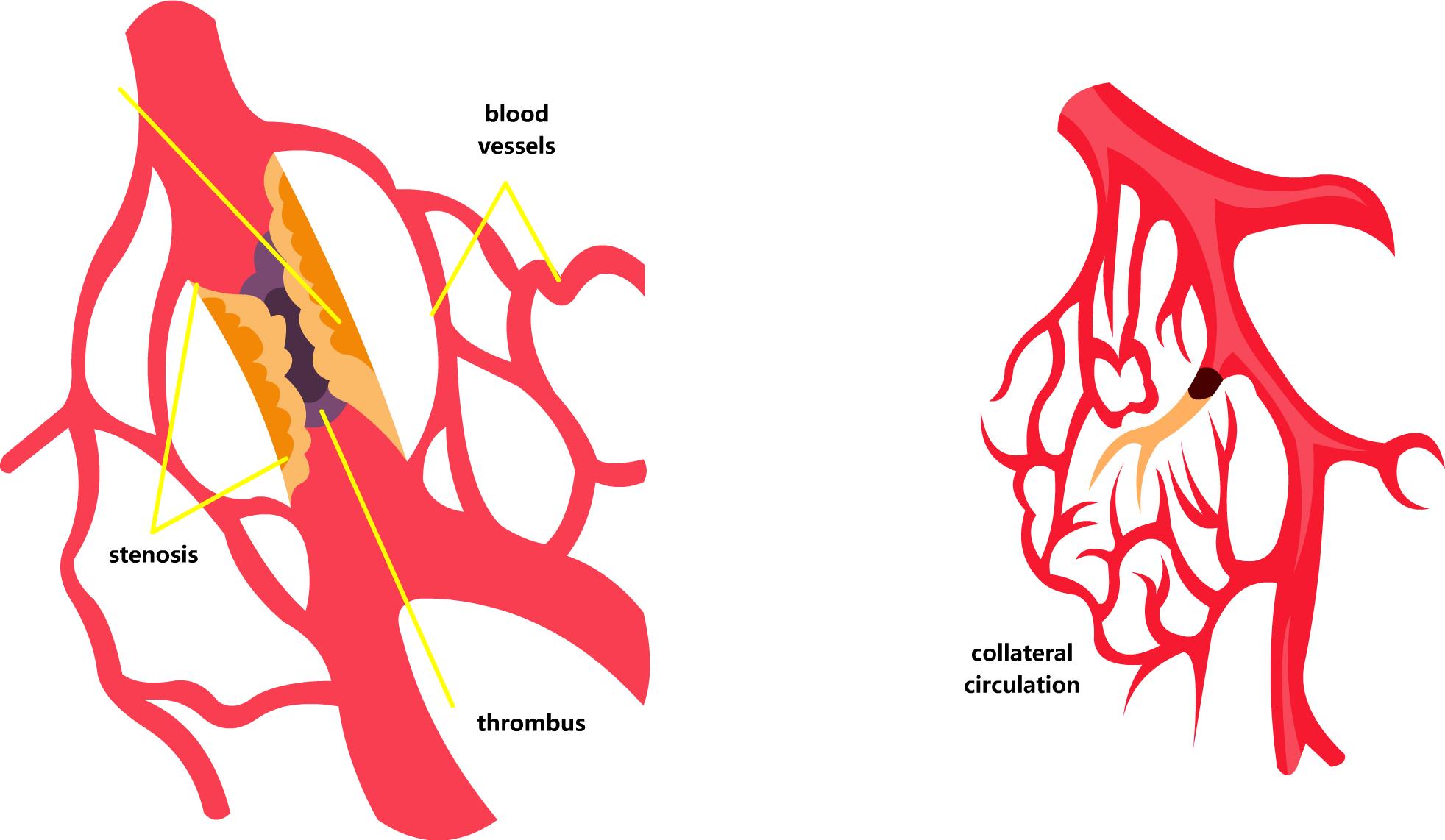 冠脉侧支循环建立条件,什么是冠脉侧支循环
