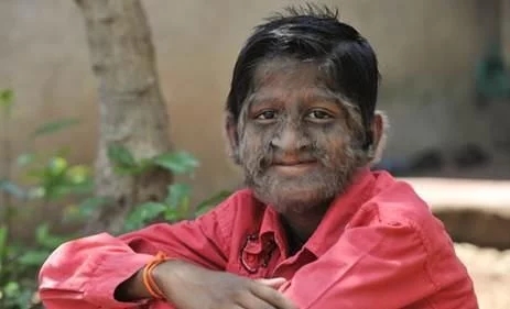 女性体毛重的症状,女性体毛多是什么原因造成的