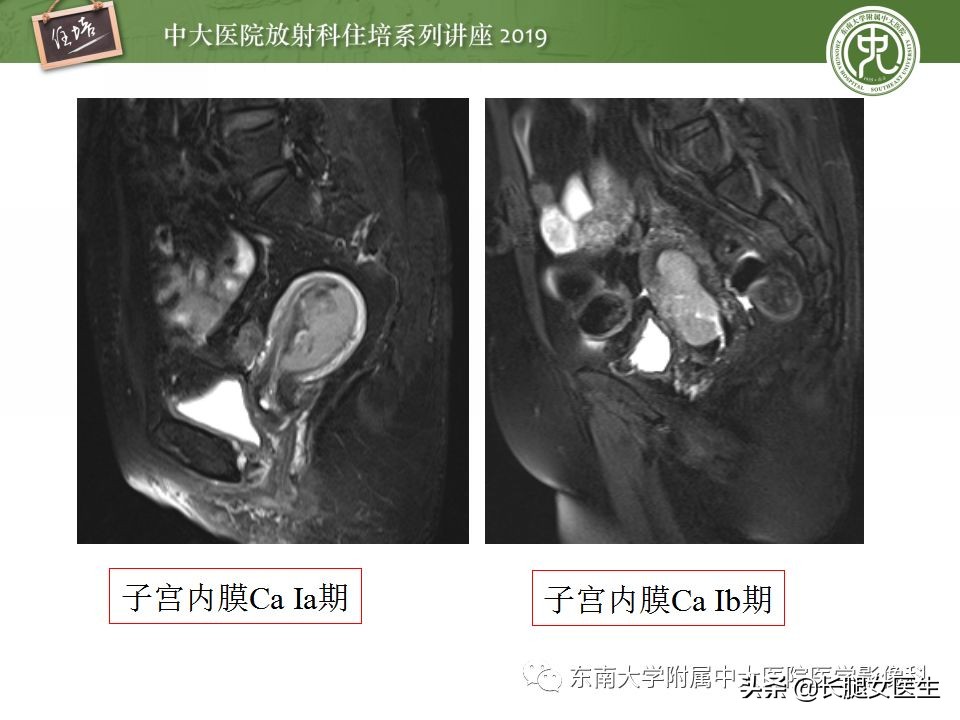 女性生殖子宫影像解剖及生理改变