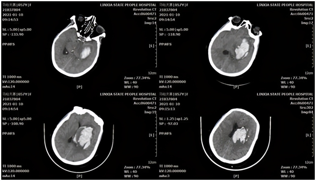 基层医院神经外科微创脑出血前景,高血压脑出血新突破