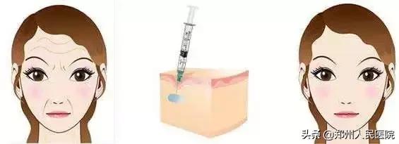 别急！注射玻尿酸之前，先弄清楚这几件事儿