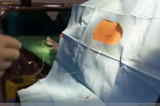 剖腹产必须知道的几件事,剖腹产的宝宝四大优点