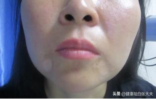 代购的护肤品伤害皮肤,用劣质化妆品导致了白癜风