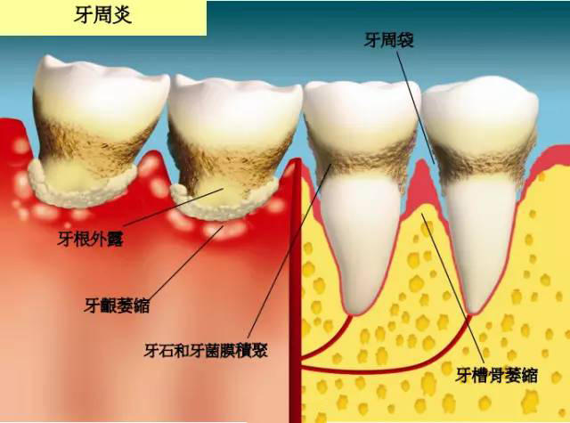 牙齿松了如何固齿,撞松牙齿松动了怎么样才能固齿