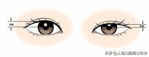 大小眼整形对比图片,大小眼适合什么样的眼部整形