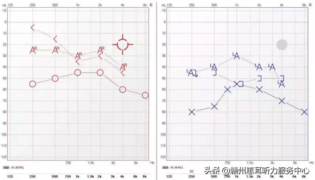 耳硬化症通过什么检查,耳硬化症的诊疗计划