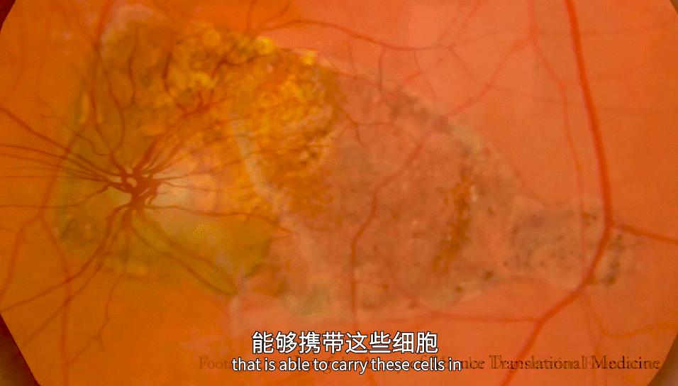 全球超过22亿人视力受损，干细胞疗法逆转过去无法治愈的失明