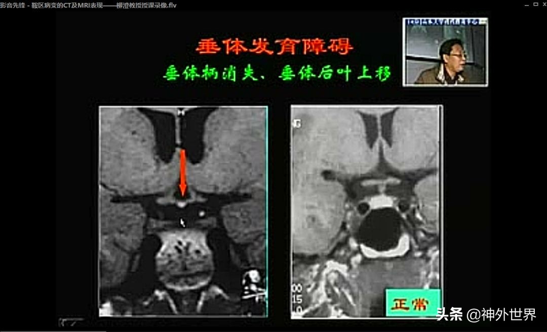 鞍区核磁解剖图,鞍区解剖与手术