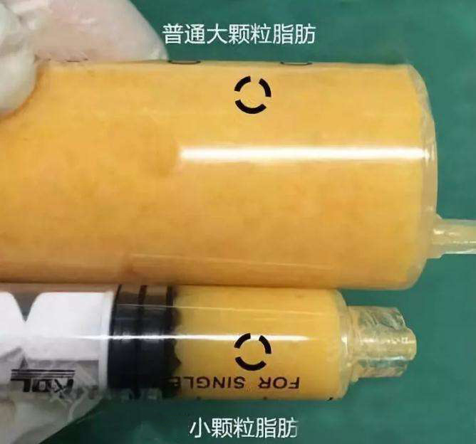 全脸填充纯脂肪和svf有什么区别,干细胞和脂肪填充的区别