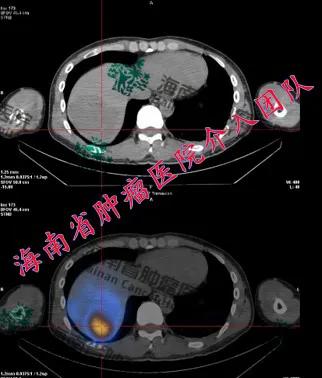 肝癌Y90树脂微球介入治疗技术临床应用落地海南