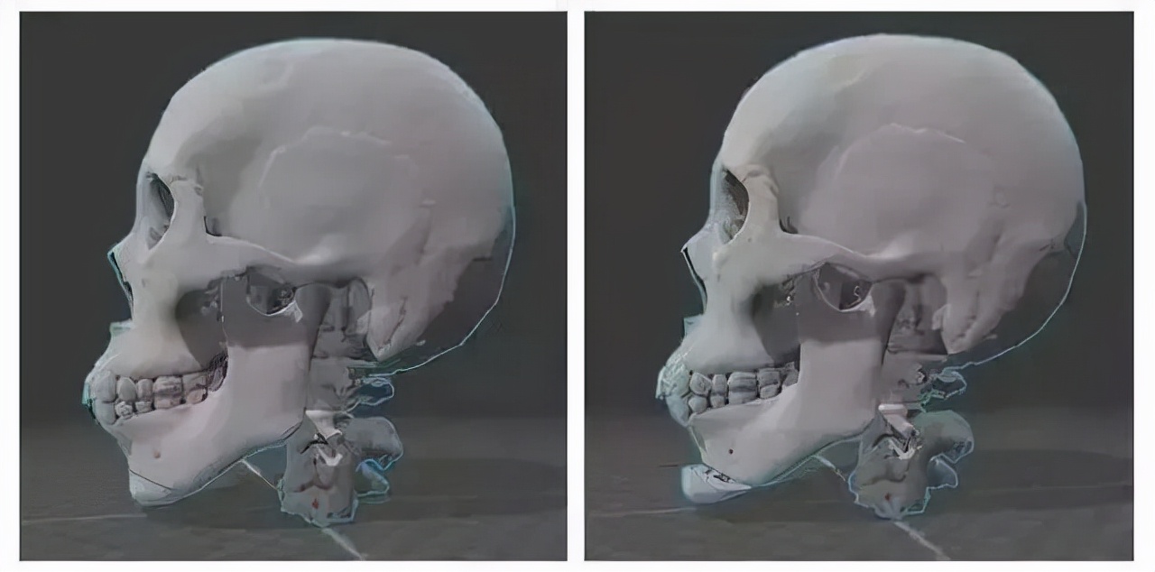 韦敏削骨怎么样,韦敏做peek下巴多少钱