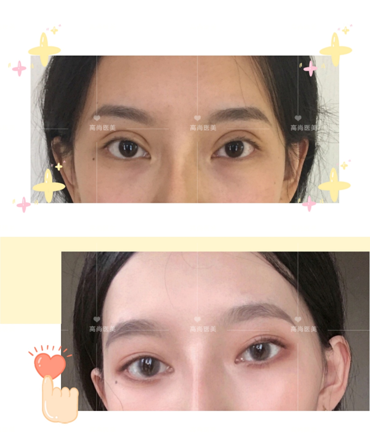 余文林整容后需要住院多久,余文林失败案例