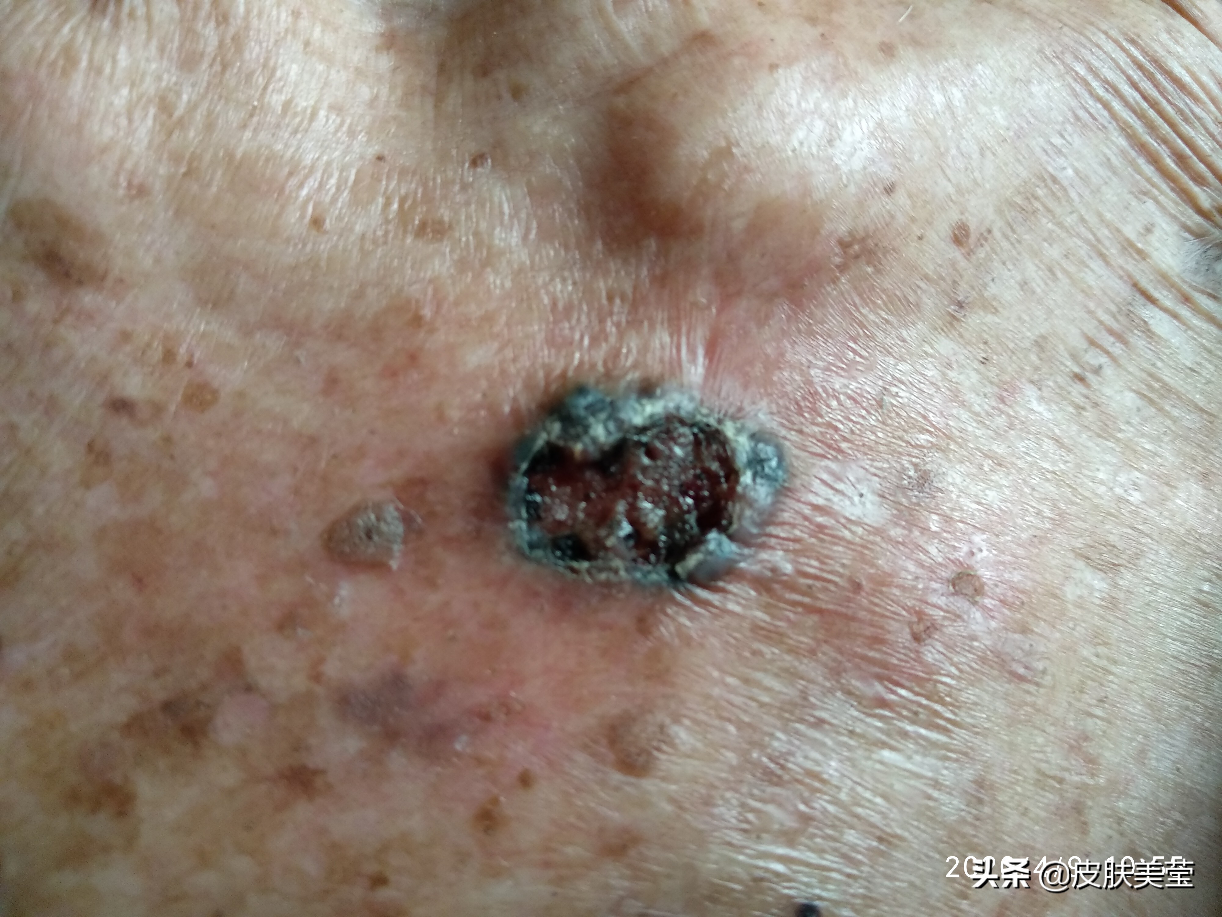 关于皮肤癌的相关知识,皮肤癌有治好的希望吗