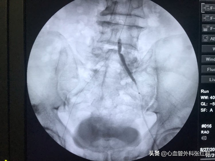 外周血管外科治疗范围,外周血管介入治疗疗程