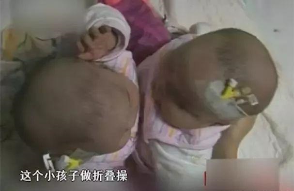 连体双胞胎坐骨连在一起,首例坐骨连体分离11年