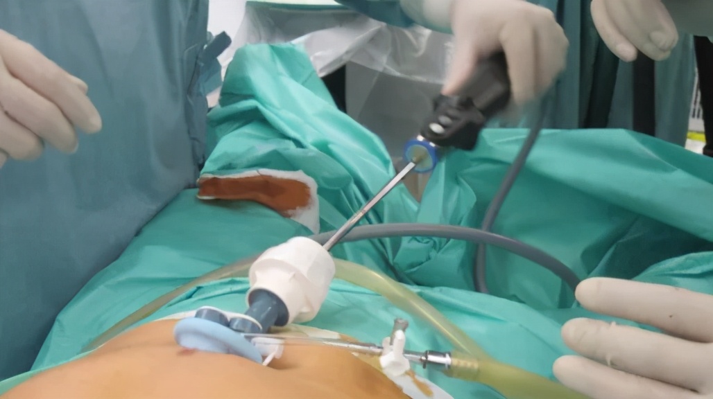 单孔腹腔镜技术,腹腔镜在肝胆外科应用新进展