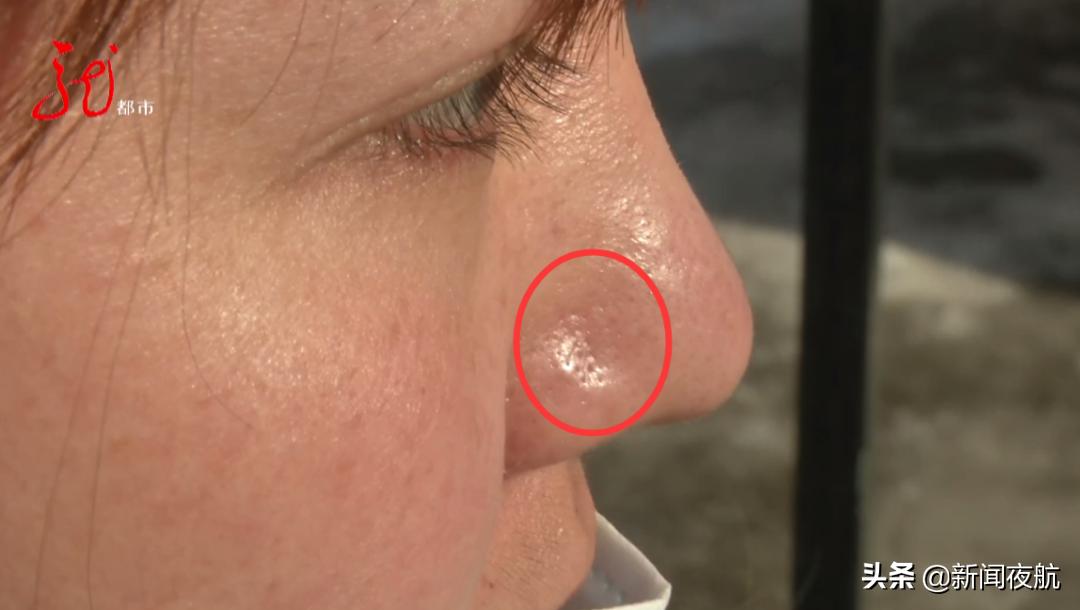 做完小气泡后鼻子肿了什么情况,做完小气泡鼻子肿大