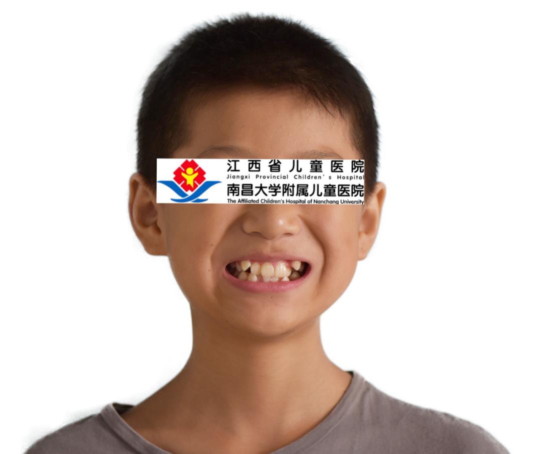 有没有办法把长歪的牙齿矫正,成年牙齿歪了怎么矫正大概要多久