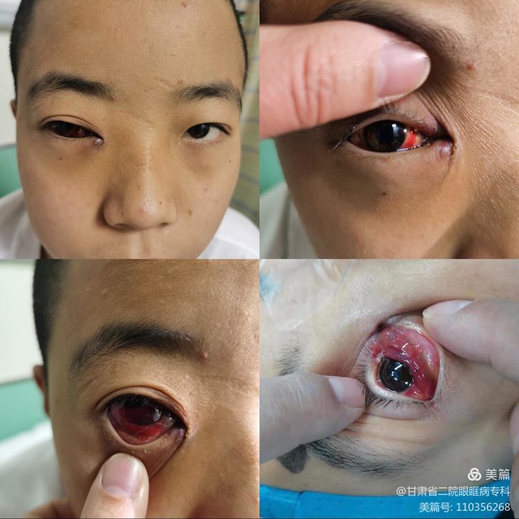 眼眶血管畸形介入治疗多少钱,眼眶血管畸形手术