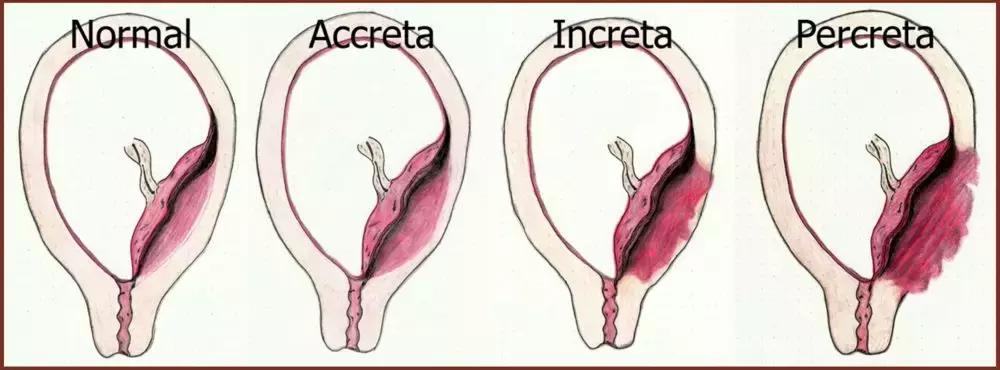 产后60天漏尿腹直肌分离怎么改善,产后如何防止子宫下垂腹直肌分离