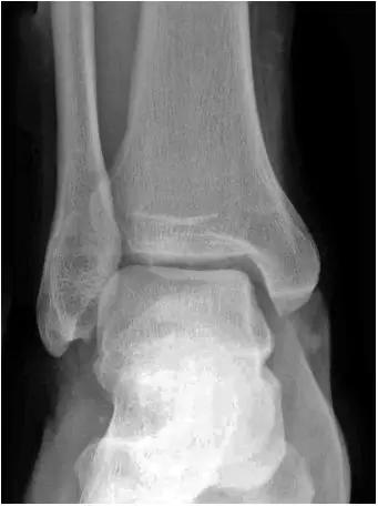 踝关节撞击症问诊,踝关节内侧撞击综合症位置图